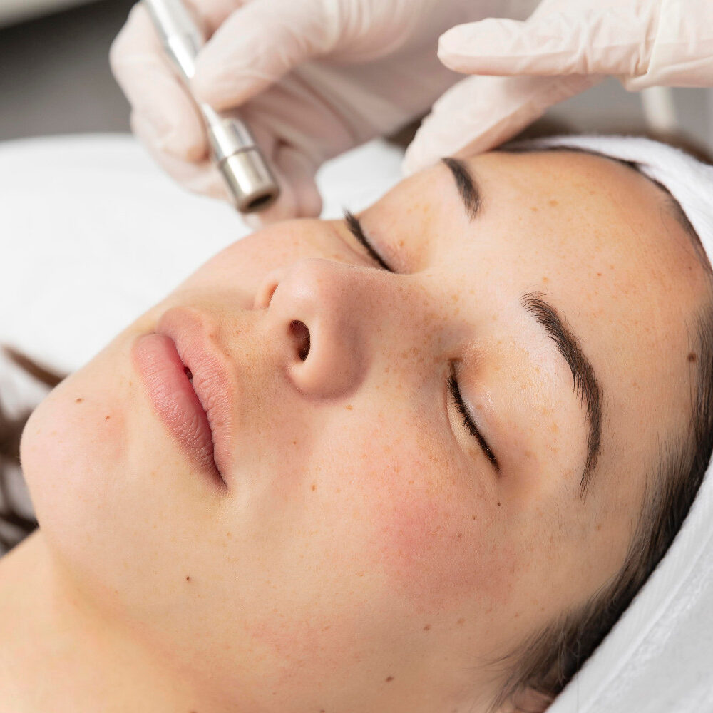 microdermabrasion